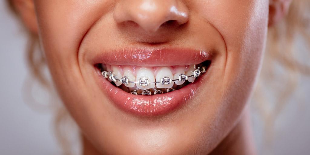 Braces: Unlocking a Lifetime of Confident Smiles